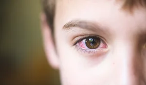 9757 Bindehautentzündung: Ein Junge mit einem roten Auge