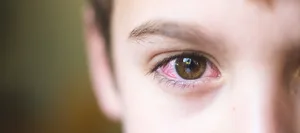 9757 Bindehautentzündung: Ein Junge mit einem roten Auge