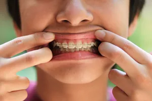 Header_braces Construction site dentures